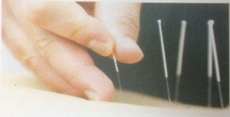 1. Look at the picture, do you know anything about acupuncture